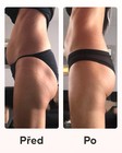 Výsledky metody proti celulitidě před a po