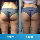 Pack Expert Anti-Cellulite - 7