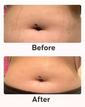 Cellublue stretch mark repair full routine products overview