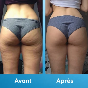Méthode Anti-Cellulite - 3