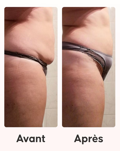 Résultat peau ferme et tonique après programme minceur