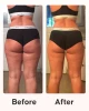 Before and after results using Cellublue Maxi Cellulite Pack