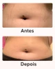 Pack maxi anti-estrias Cellublue conteúdo completo do kit