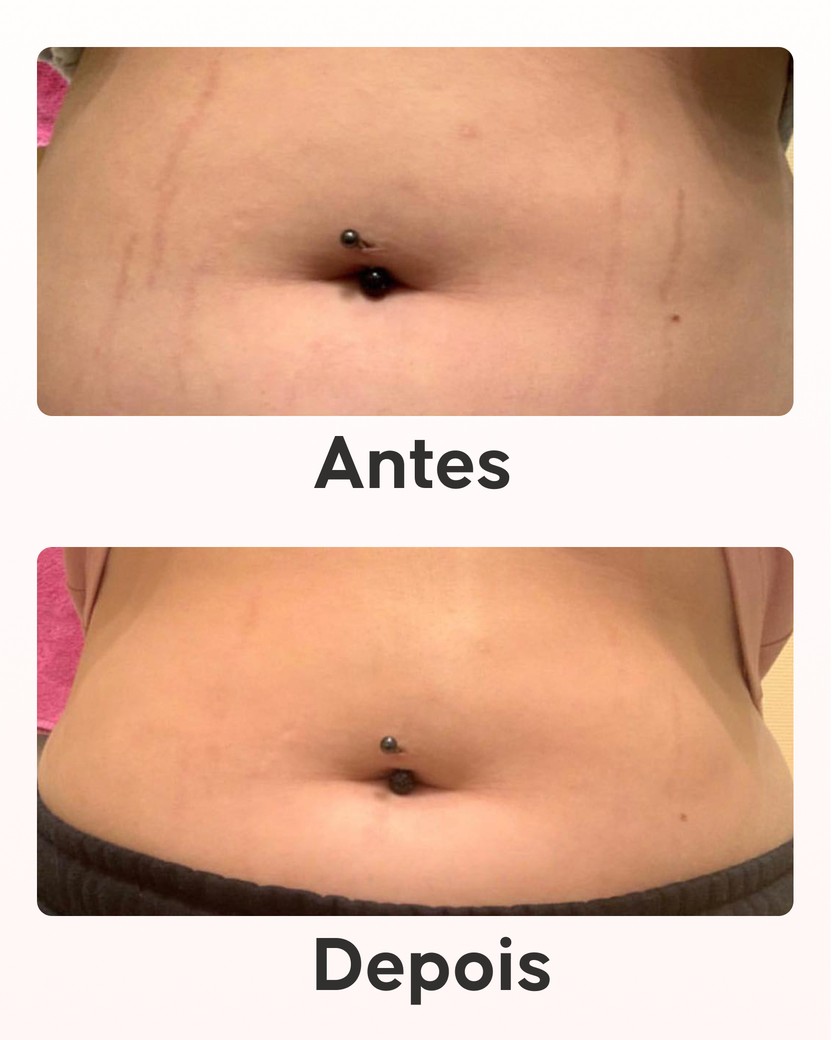 Pack maxi antiestrias Cellublue com creme reparador intensivo
