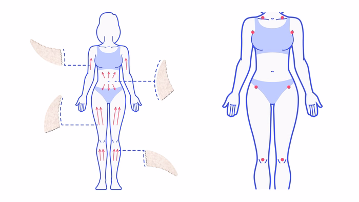 Le Drainage Lymphatique